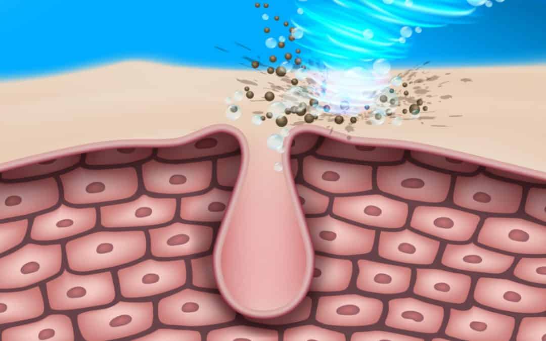 How to Clear and Prevent Cystic Acne
