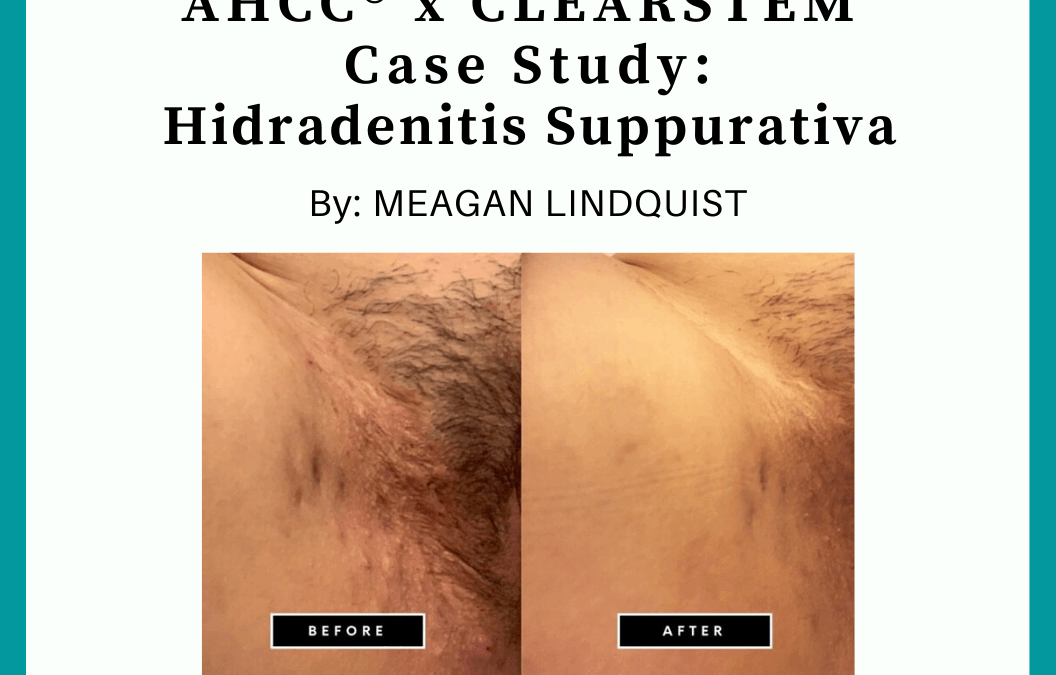 AHCC® Case Study: Hidradenitis Suppurativa