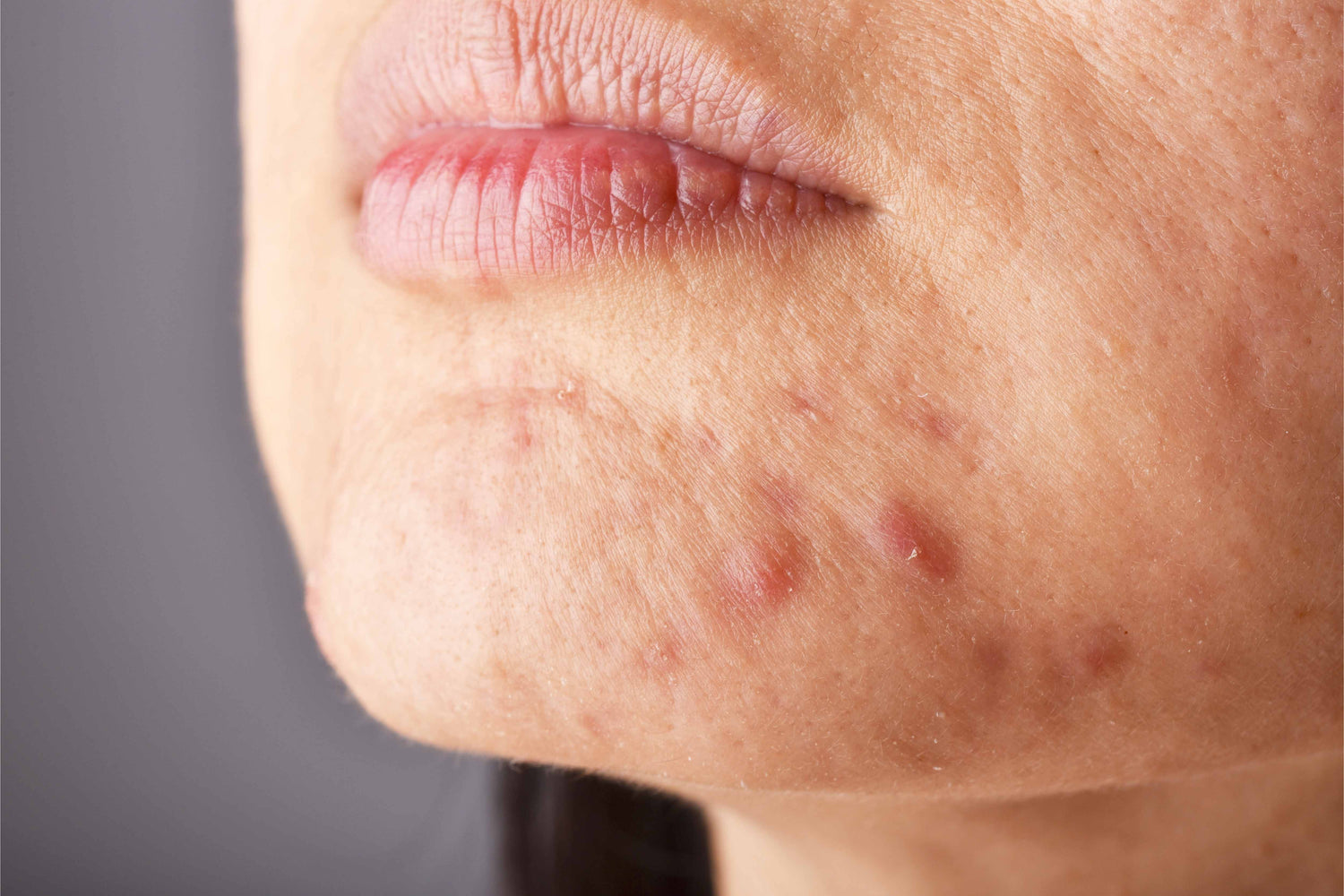 Got Adult Acne? Here's What to Do