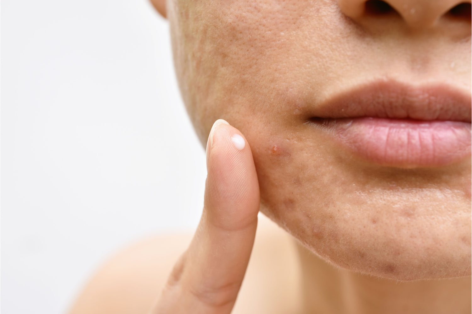 Acne vs. Pimples: How to Tell the Difference