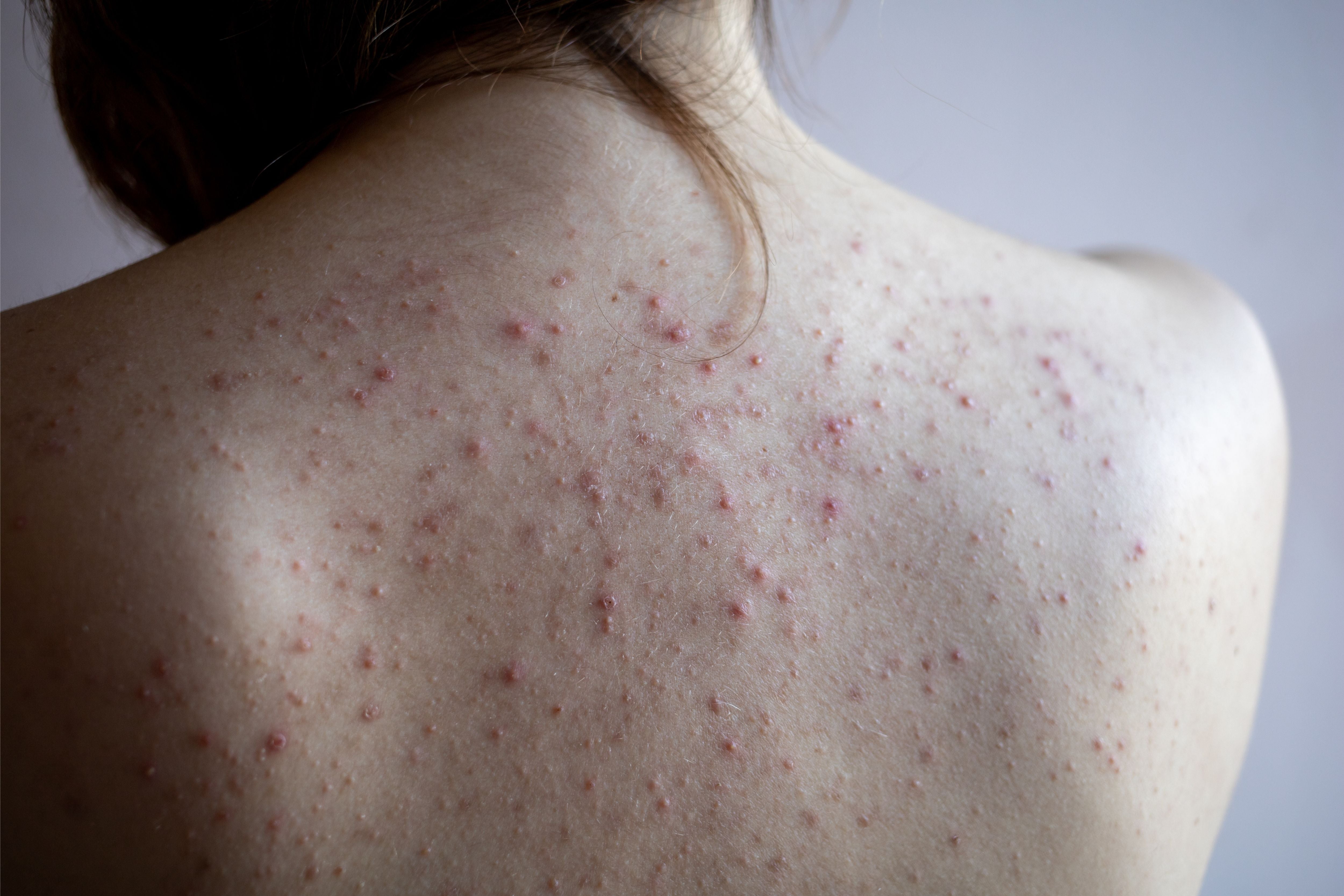 How to Get Rid of Back Acne & Scars Naturally