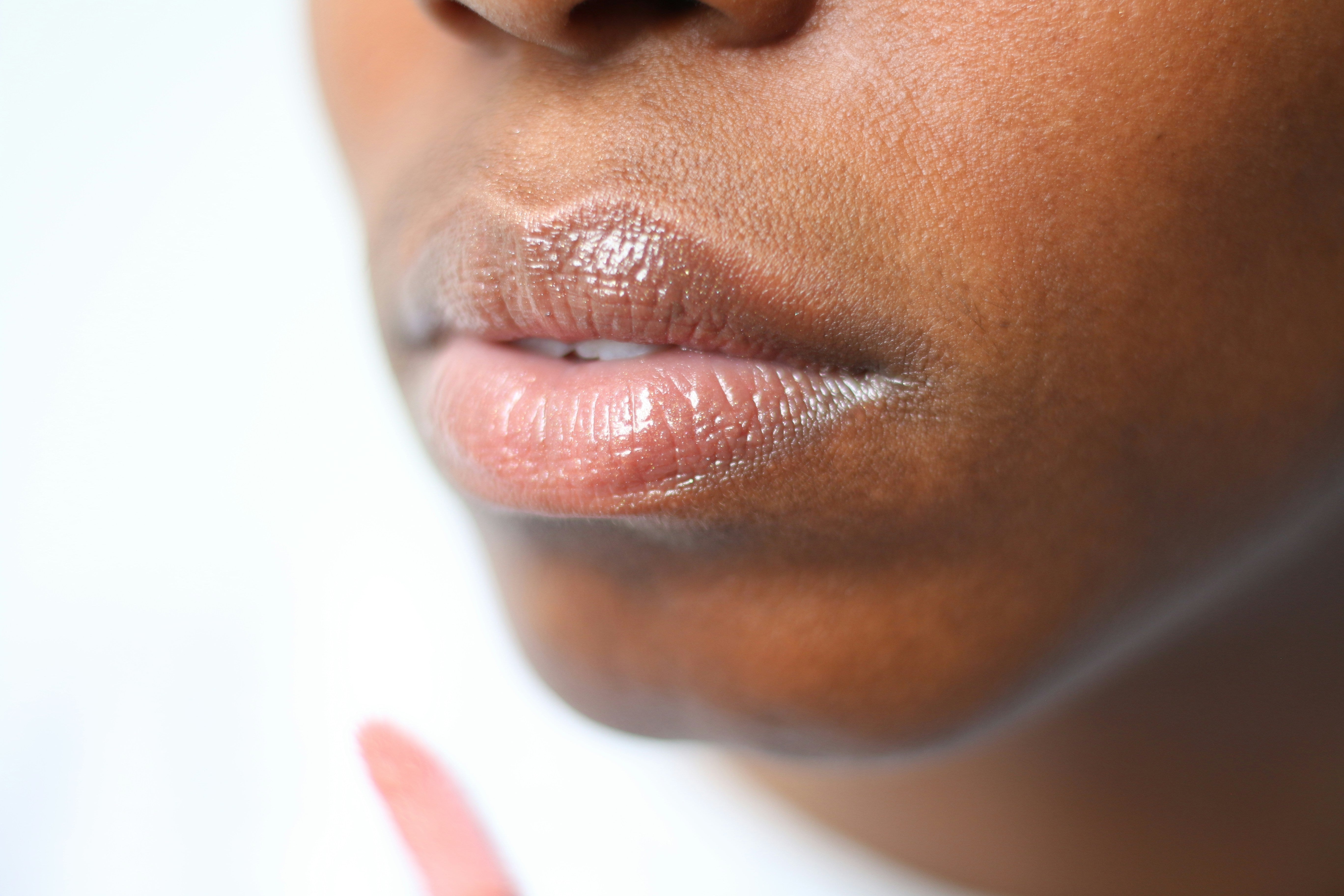 Acne Around the Mouth & Chin: What You Need to Know