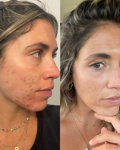 before and after clearstem skincare